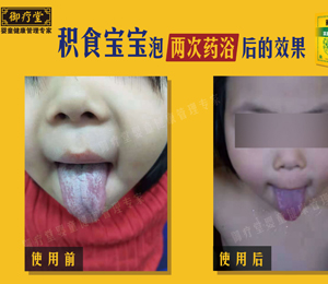  御療堂藥浴積食寶寶對(duì)比舌苔 1